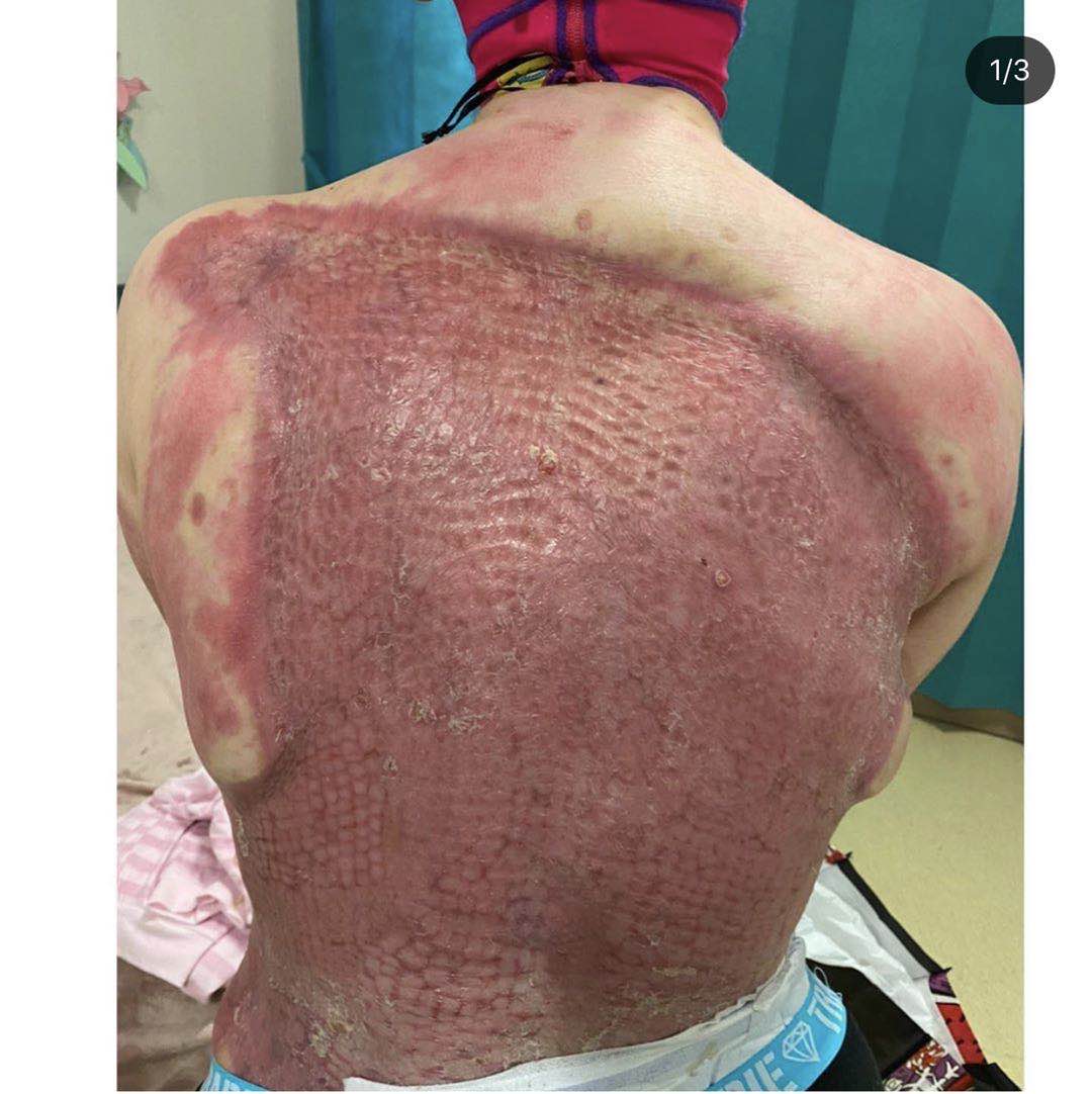 24岁的墨尔本美少女,一夜之间失去了健康与美貌!70%皮肤坏死,手指被切除,她却大方地展示一切,感动了无数人…
