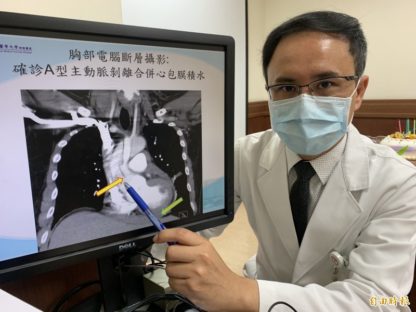 老菸枪主动脉剥离80公分 手术10小时救命