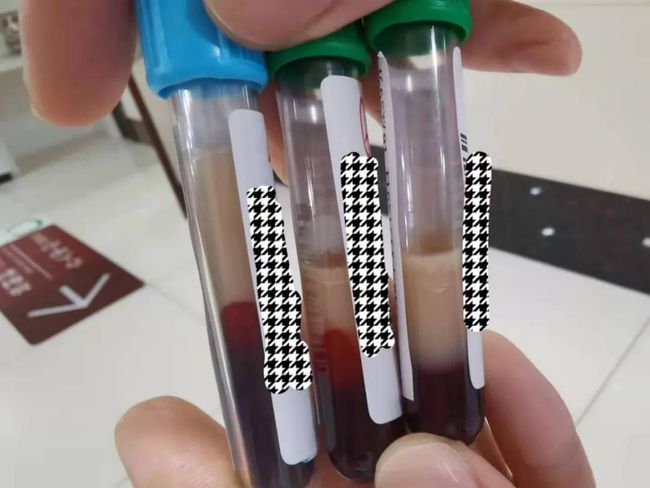 杭州一老总腹痛被送急诊 医生:抽血抽出了半管油