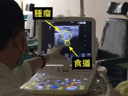 喉咙卡卡吞咽异物感 超音波检查竟是甲状腺肿瘤作祟