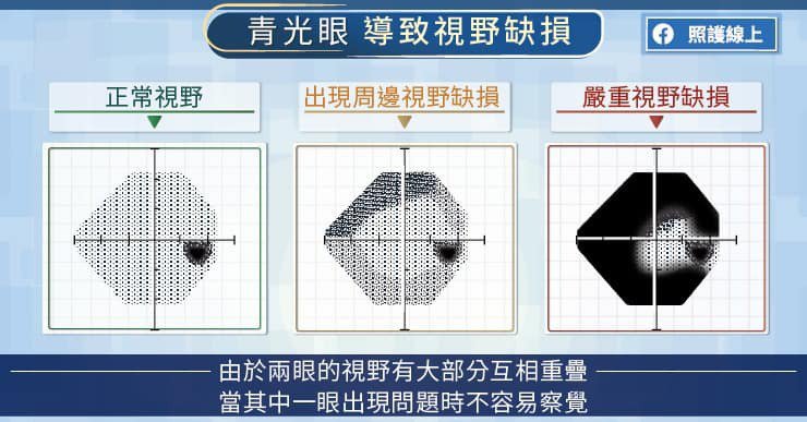眼压正常不见得没事!医:多数青光眼患者没自觉