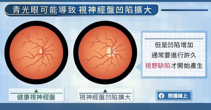 眼压正常不见得没事!医:多数青光眼患者没自觉