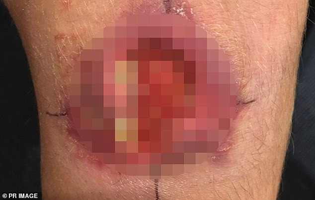 别以为蚊虫叮咬是小事,维州「食肉菌」扩散严重恐截肢!