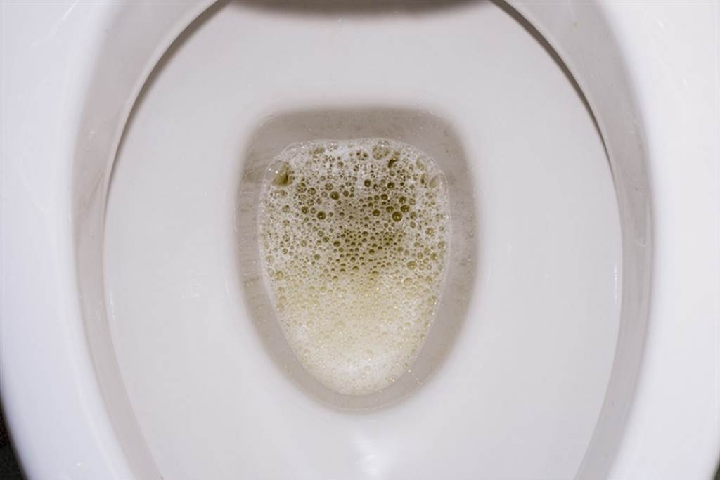 泡泡尿是洗肾前兆?医解答「透析条件」