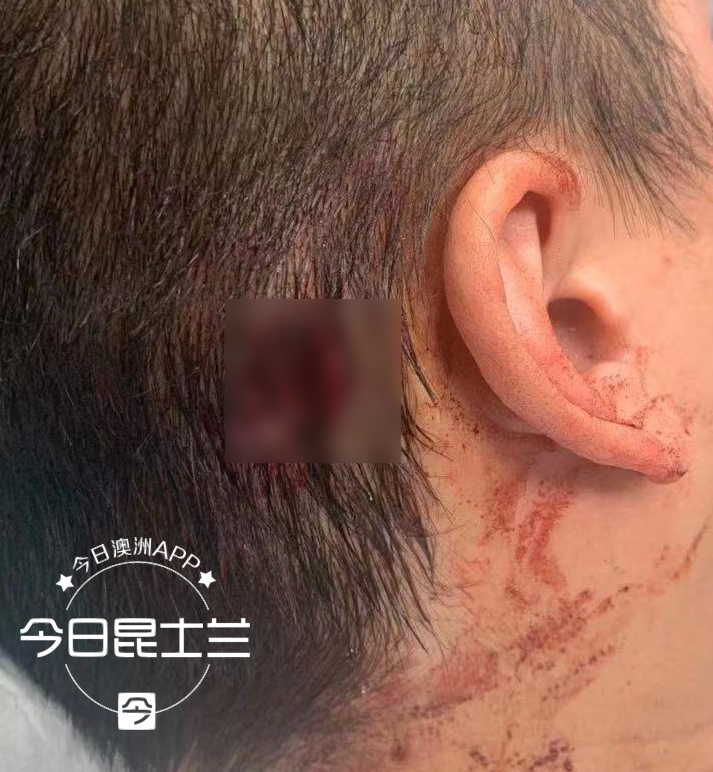 澳华男停车场遇袭,被人从身后锤头,流血不止,“现在一起身天旋地转!”华人遇到这种情况警惕