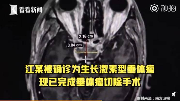 以为发福…中年男「长高变胖」 竟是颅内肿瘤惹祸