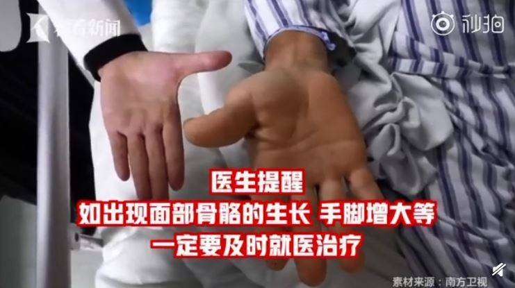 以为发福…中年男「长高变胖」 竟是颅内肿瘤惹祸