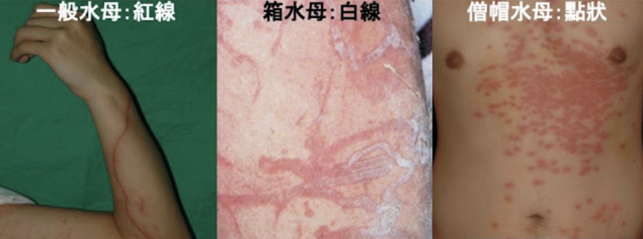 昆州女遭剧毒箱型水母螫伤,用醋冲洗及时救命!