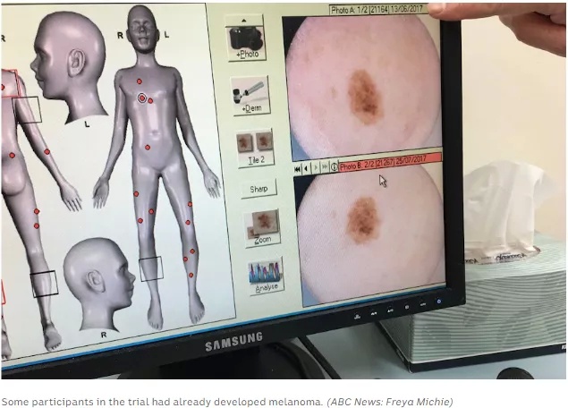 谨防小痣变癌!澳大学研究:儿童7岁之前晒伤易诱发黑色素瘤
